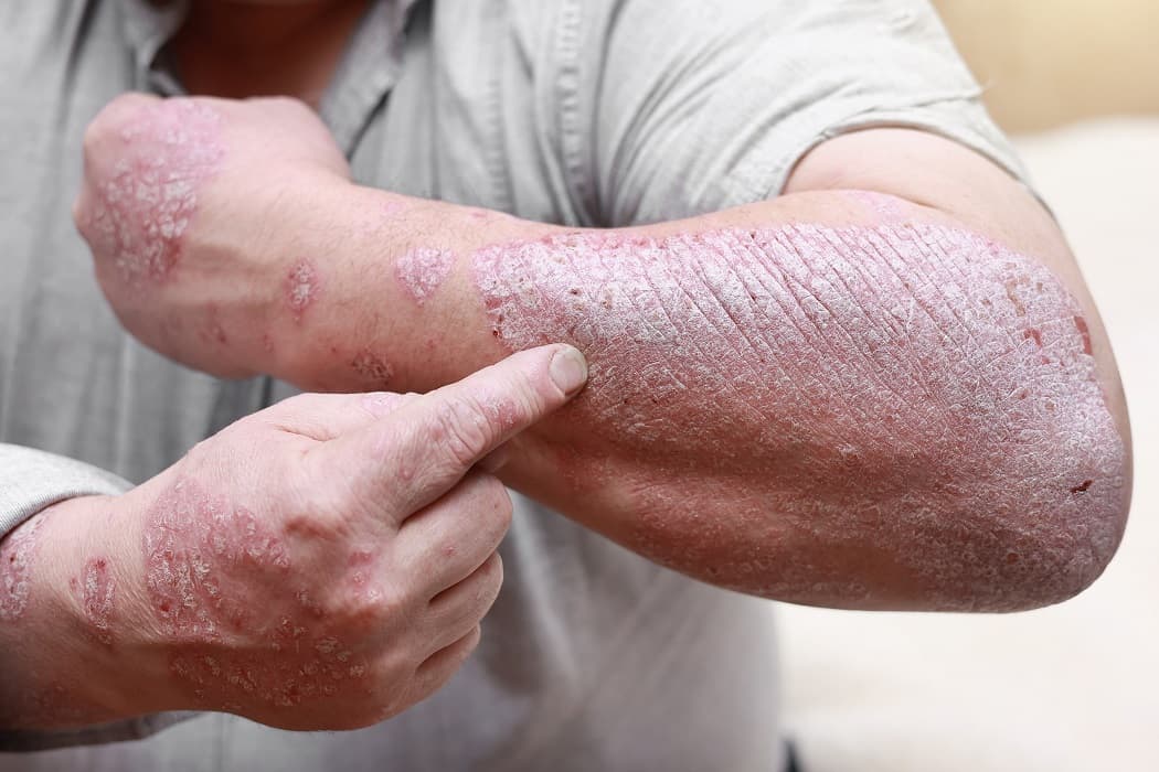 What is Psoriasis