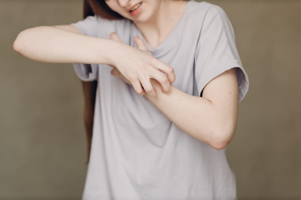 What is scabies